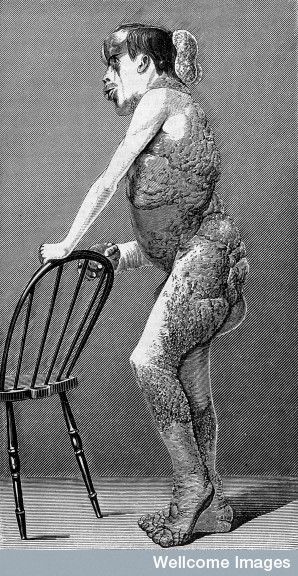 Joseph Merrick ("Elephant Man") im Profil, 1886